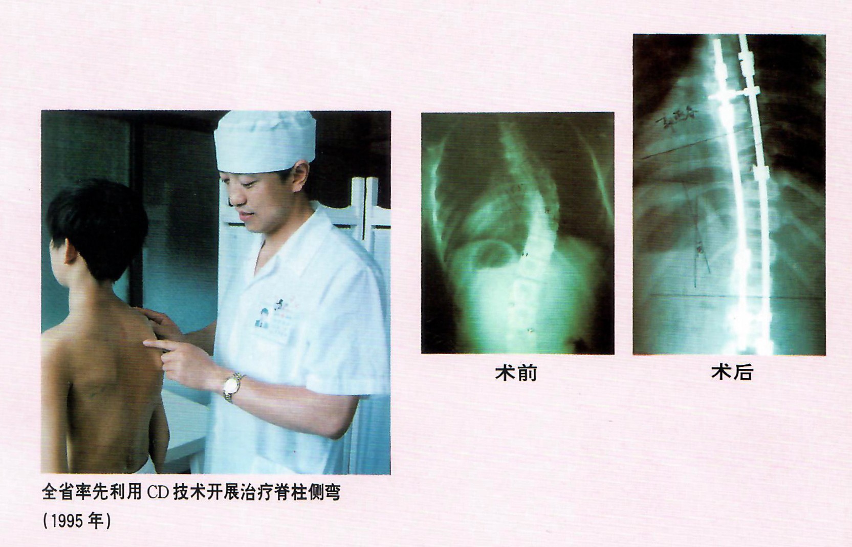 1995年，林海濱教授做了福建省第一例CD技術(shù)矯正脊椎側(cè)彎手術(shù).jpg